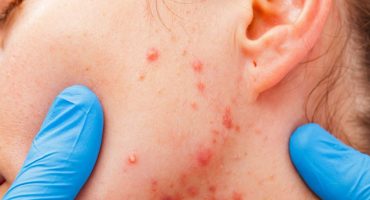 Acne e Couperose / Rosácea