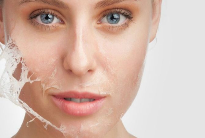Peeling Químico