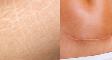 Cicatrizes e Estrias