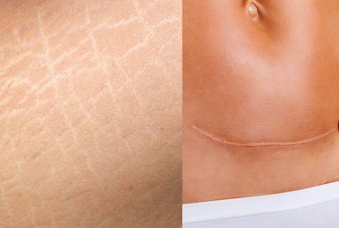 Cicatrizes e Estrias