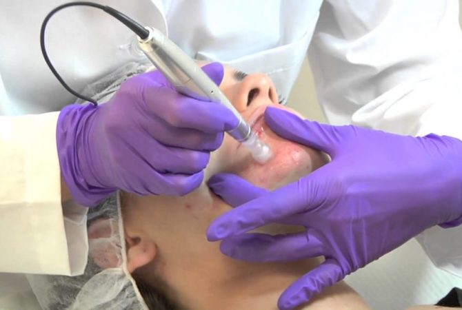 Microagulhamento com Caneta Meso